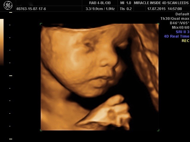 3d 4d pregnancy scan